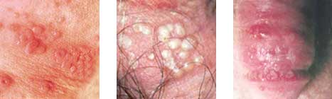 生殖器疱疹常见症状图片